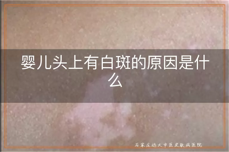 婴儿头上有白斑的原因是什么