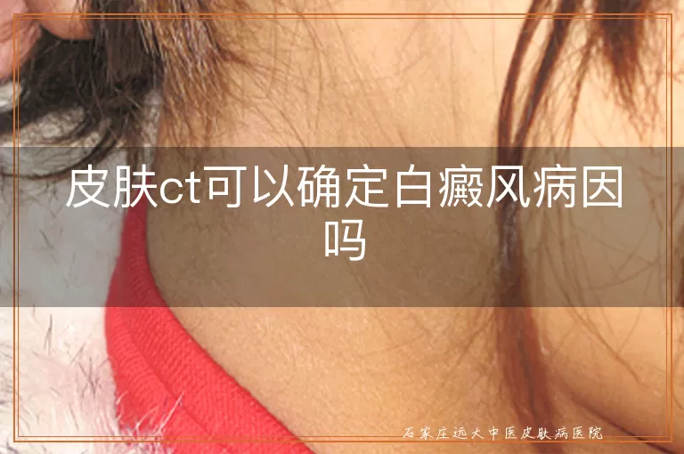 皮肤ct可以确定白癜风病因吗