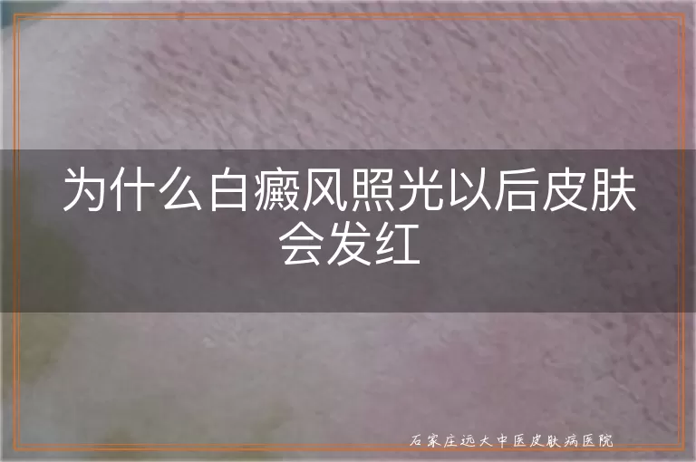 为什么白癜风照光以后皮肤会发红