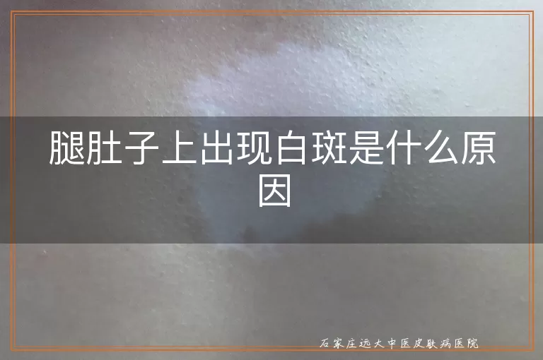 腿肚子上出现白斑是什么原因
