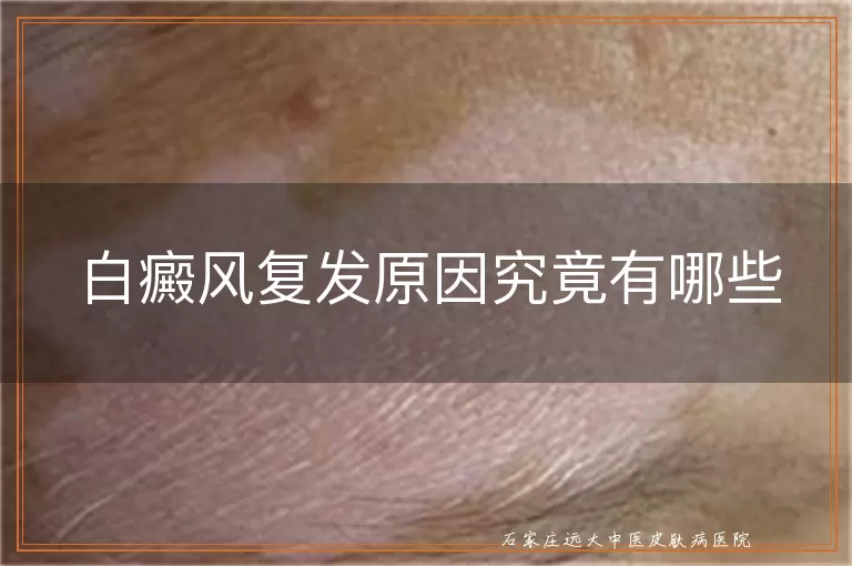 白癜风复发原因究竟有哪些
