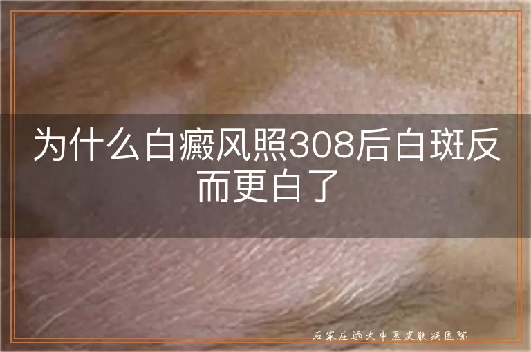 为什么白癜风照308后白斑反而更白了