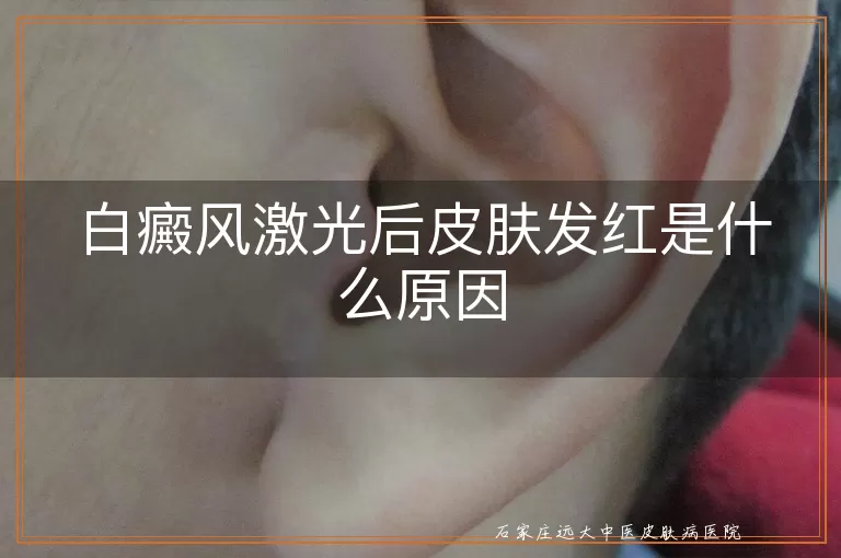 白癜风激光后皮肤发红是什么原因