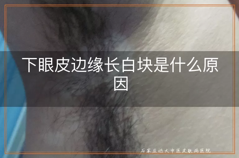 下眼皮边缘长白块是什么原因