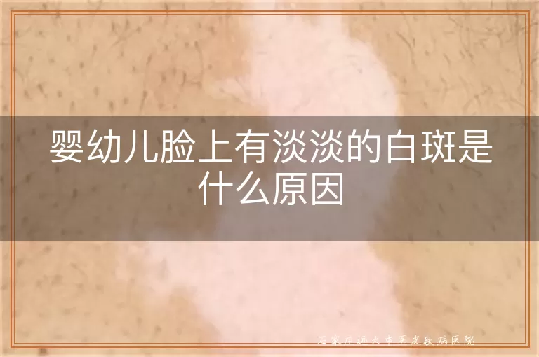 婴幼儿脸上有淡淡的白斑是什么原因