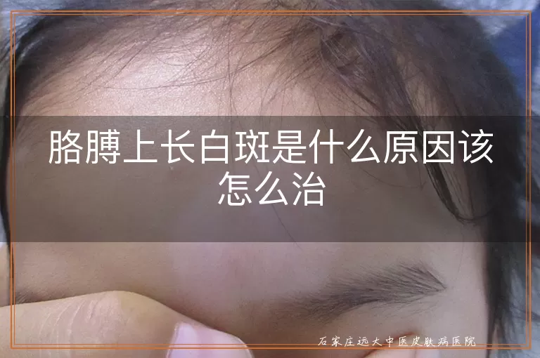 胳膊上长白斑是什么原因该怎么治