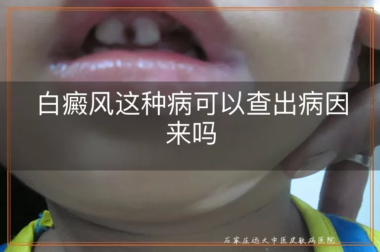 白癜风这种病可以查出病因来吗