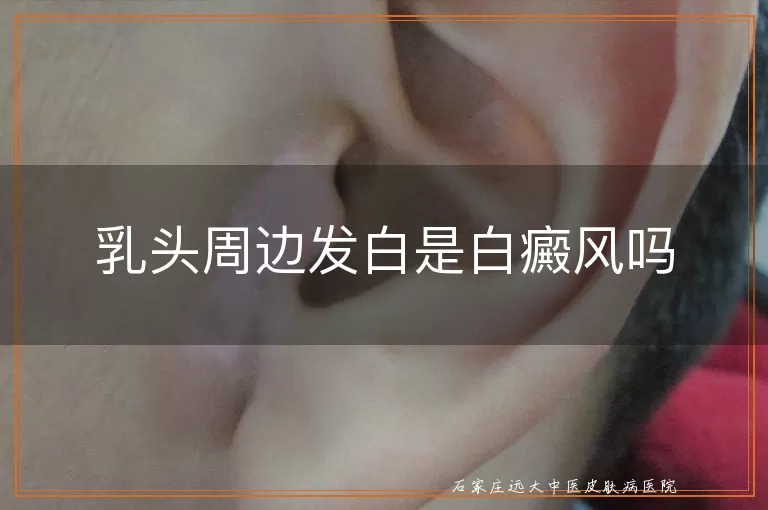 乳头周边发白是白癜风吗