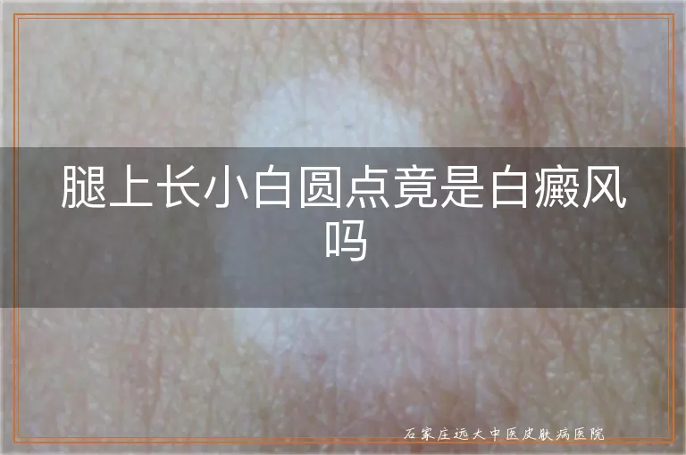腿上长小白圆点竟是白癜风吗
