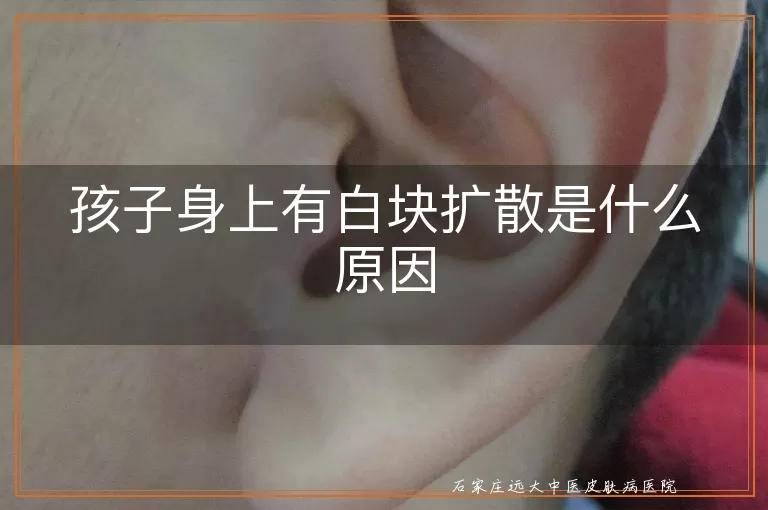孩子身上有白块扩散是什么原因