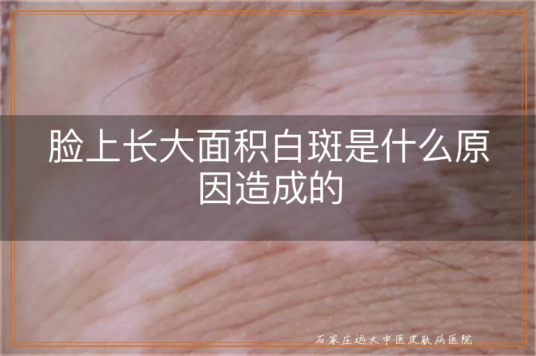 脸上长大面积白斑是什么原因造成的