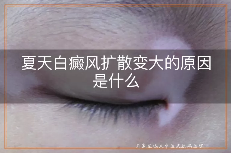 夏天白癜风扩散变大的原因是什么