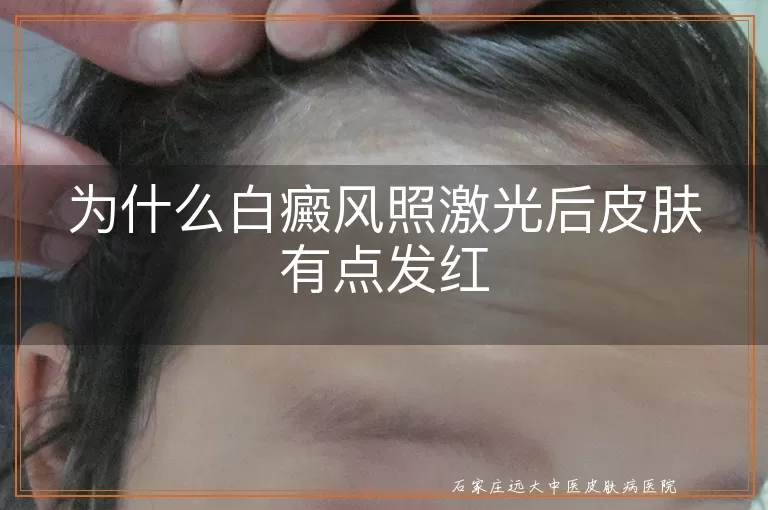 为什么白癜风照激光后皮肤有点发红