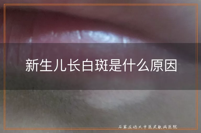 新生儿长白斑是什么原因