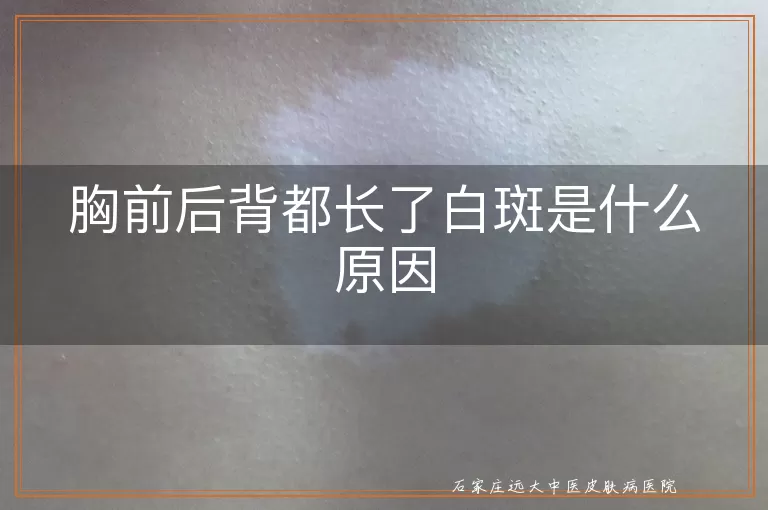 胸前后背都长了白斑是什么原因