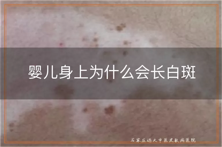 婴儿身上为什么会长白斑