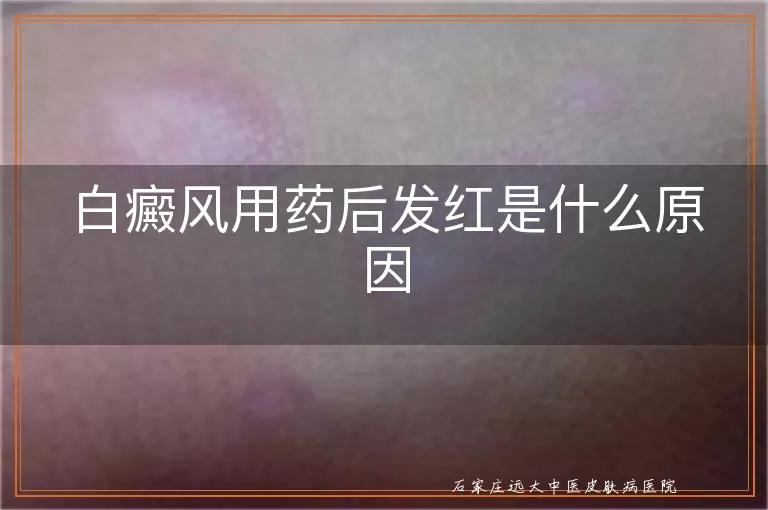 白癜风用药后发红是什么原因