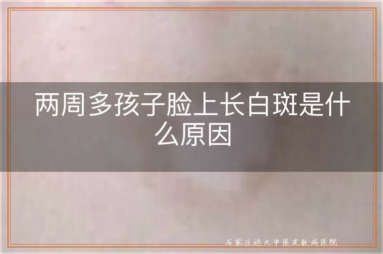 两周多孩子脸上长白斑是什么原因
