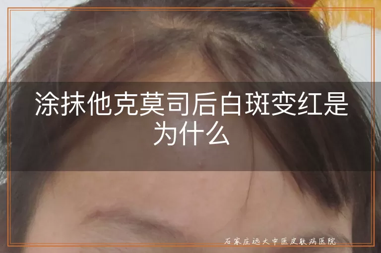 涂抹他克莫司后白斑变红是为什么