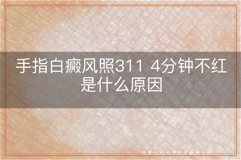 手指白癜风照311 4分钟不红是什么原因