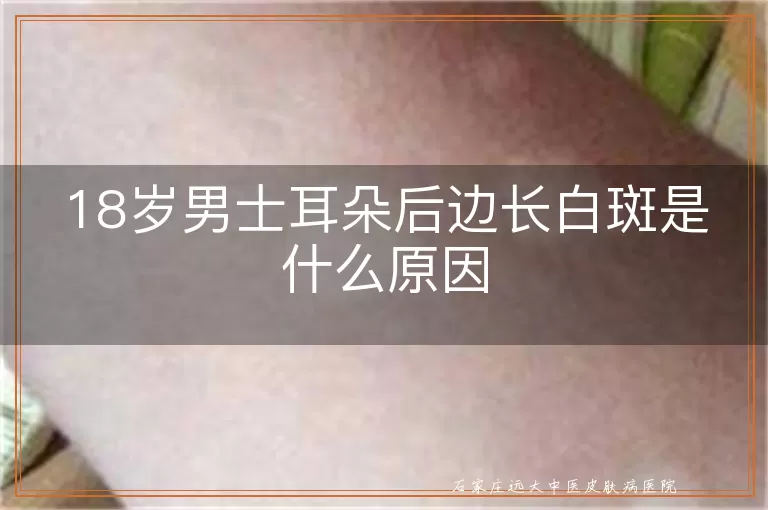 18岁男士耳朵后边长白斑是什么原因