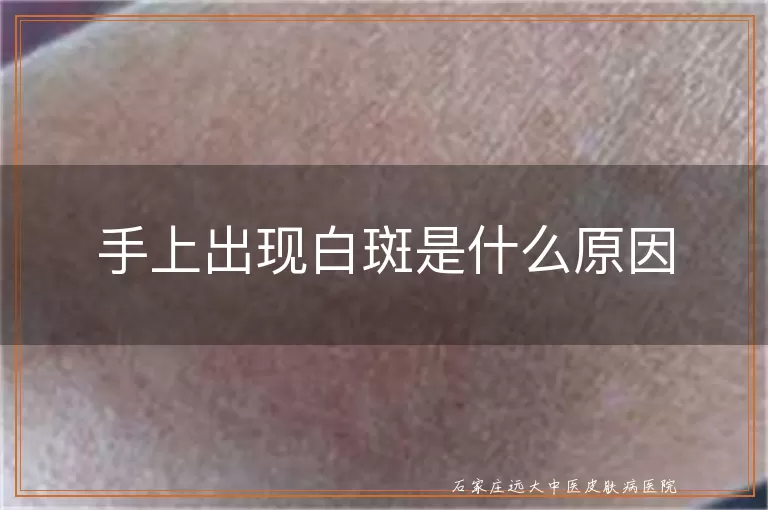 手上出现白斑是什么原因