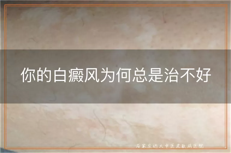 你的白癜风为何总是治不好