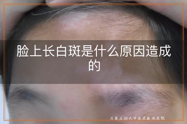 脸上长白斑是什么原因造成的
