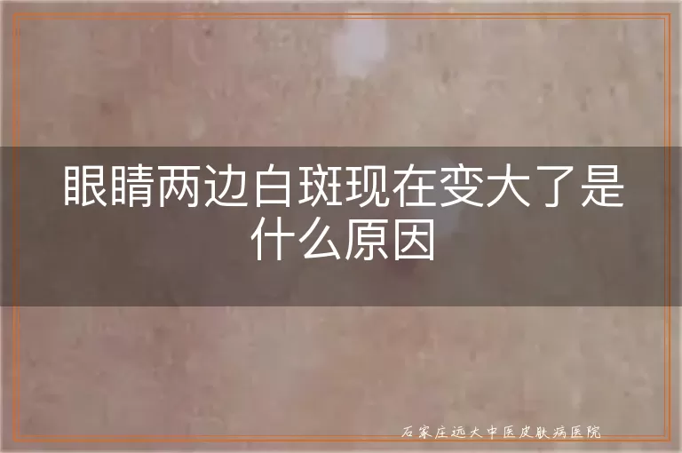 眼睛两边白斑现在变大了是什么原因