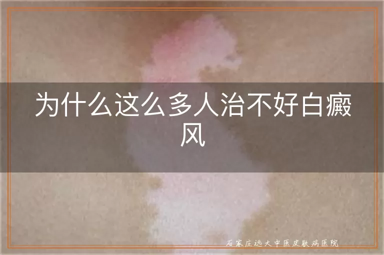 为什么这么多人治不好白癜风