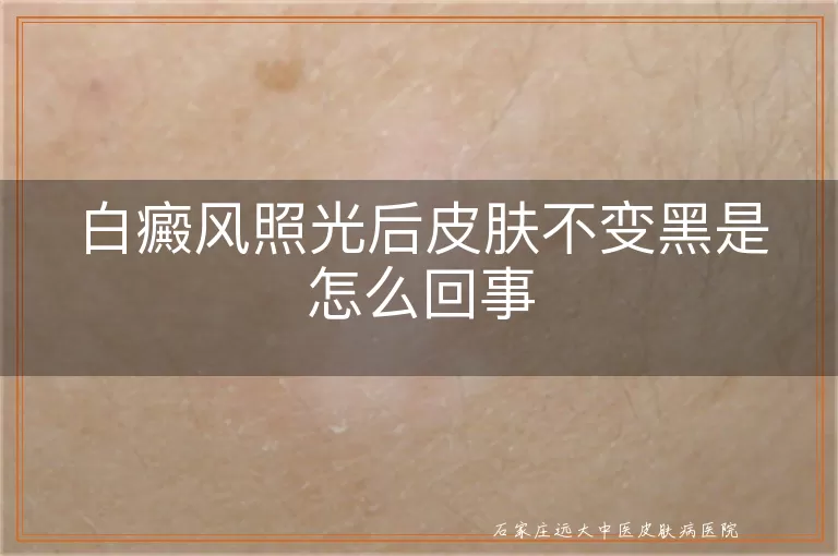 白癜风照光后皮肤不变黑是怎么回事