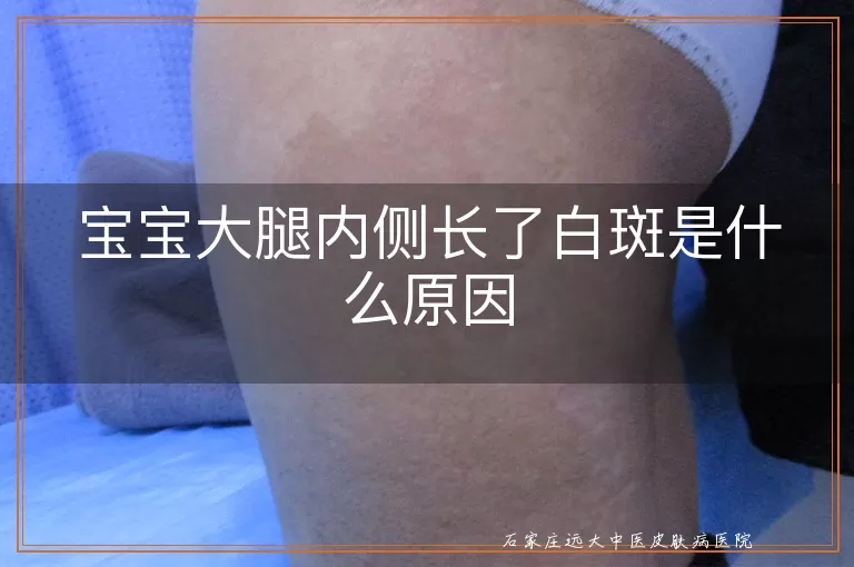 宝宝大腿内侧长了白斑是什么原因