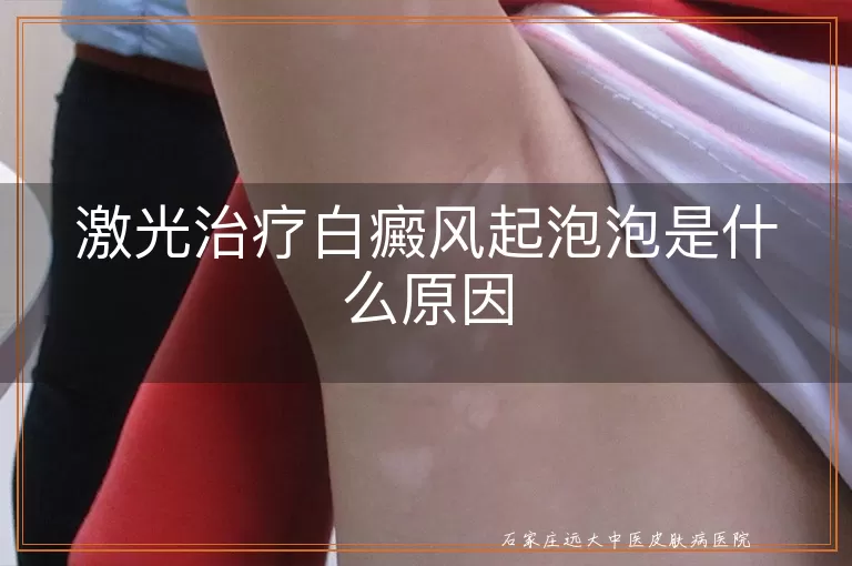 激光治疗白癜风起泡泡是什么原因