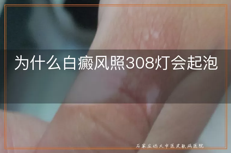 为什么白癜风照308灯会起泡