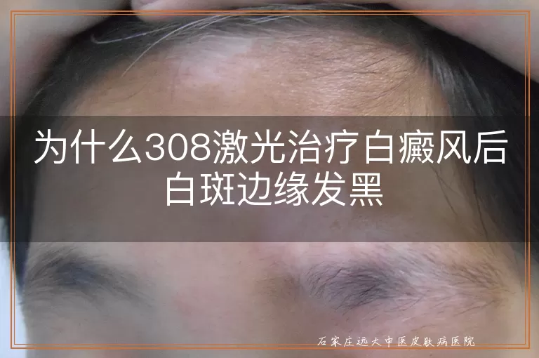 为什么308激光治疗白癜风后白斑边缘发黑
