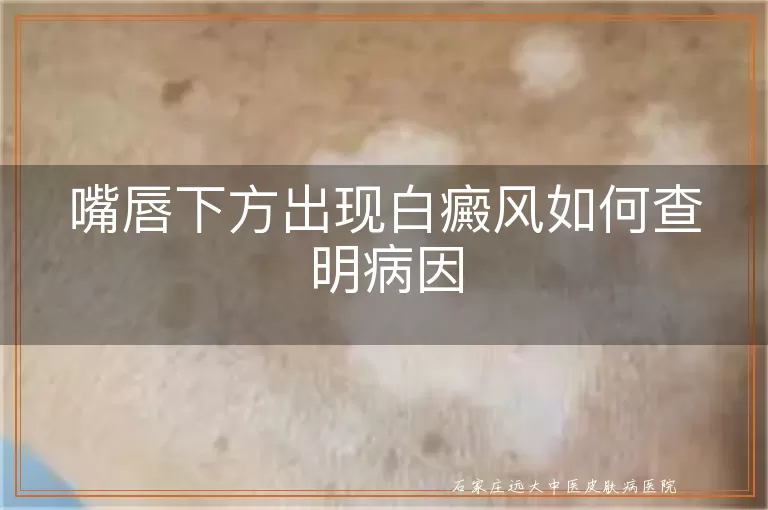 嘴唇下方出现白癜风如何查明病因