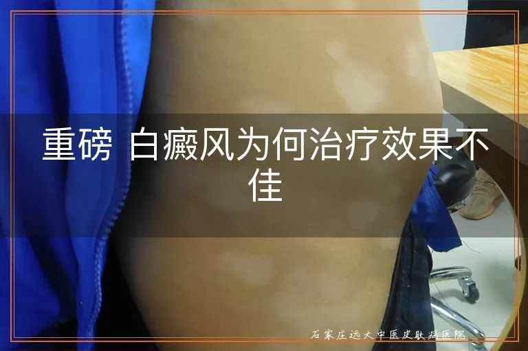 重磅 白癜风为何治疗效果不佳