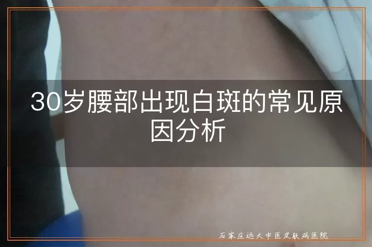 30岁腰部出现白斑的常见原因分析