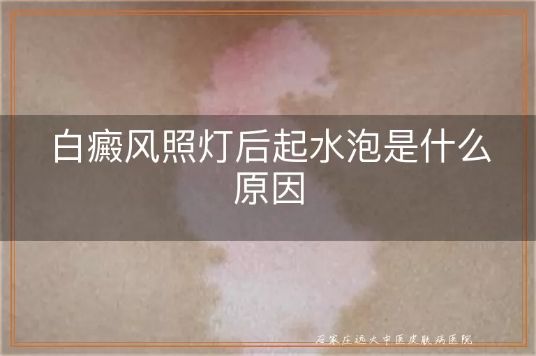 白癜风照灯后起水泡是什么原因