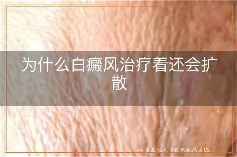 为什么白癜风治疗着还会扩散