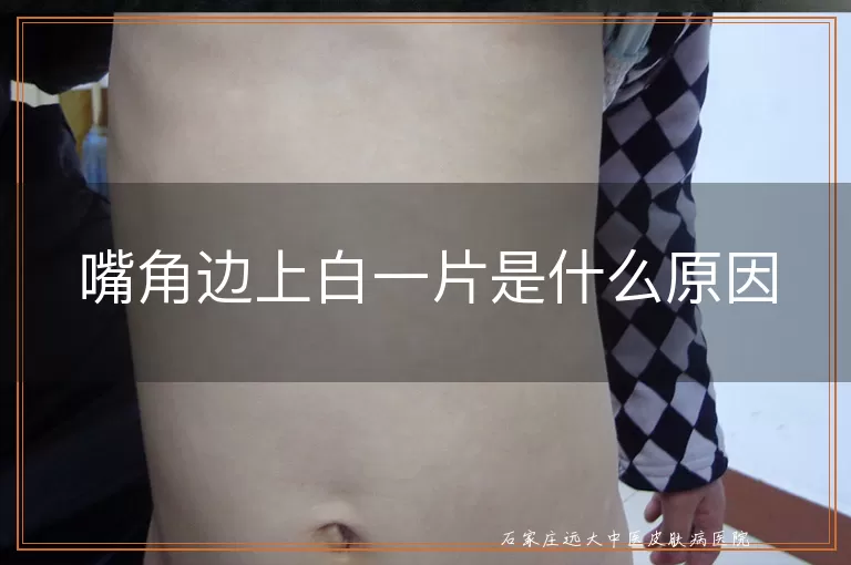 嘴角边上白一片是什么原因