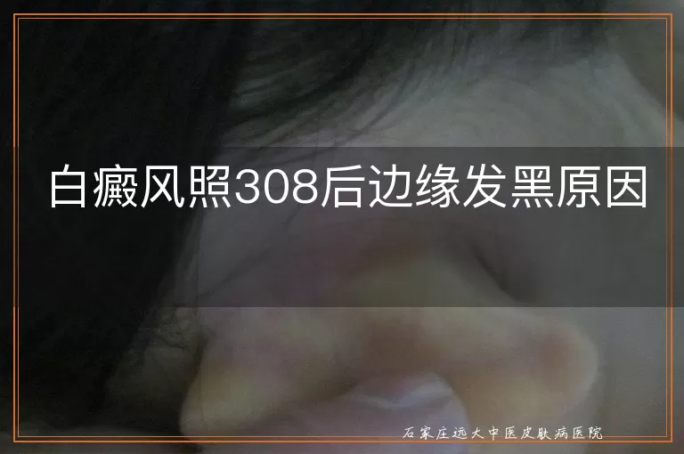 白癜风照308后边缘发黑原因