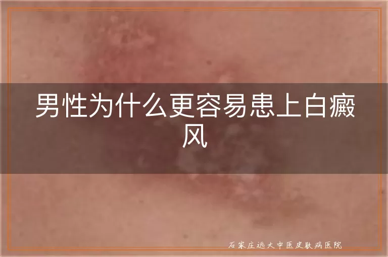男性为什么更容易患上白癜风
