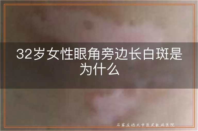 32岁女性眼角旁边长白斑是为什么