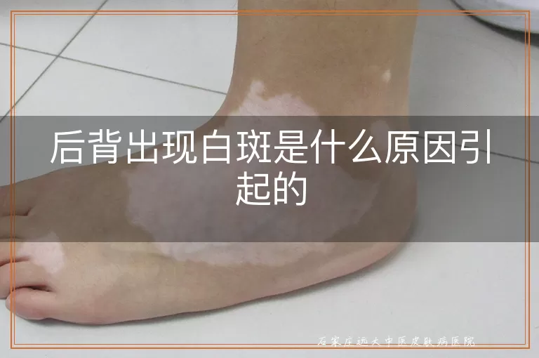 后背出现白斑是什么原因引起的