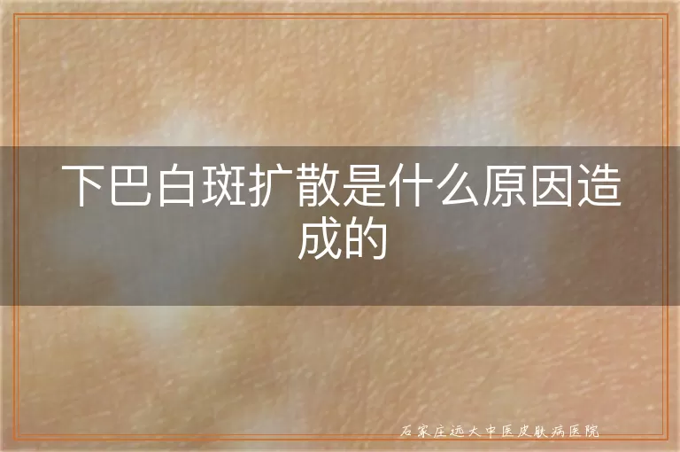 下巴白斑扩散是什么原因造成的