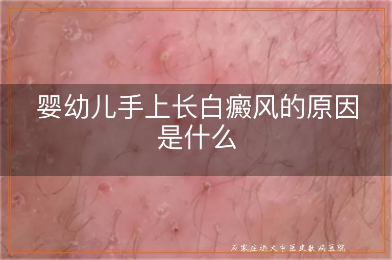 婴幼儿手上长白癜风的原因是什么