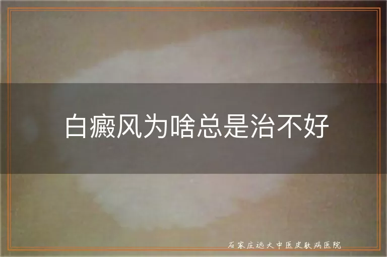 白癜风为啥总是治不好
