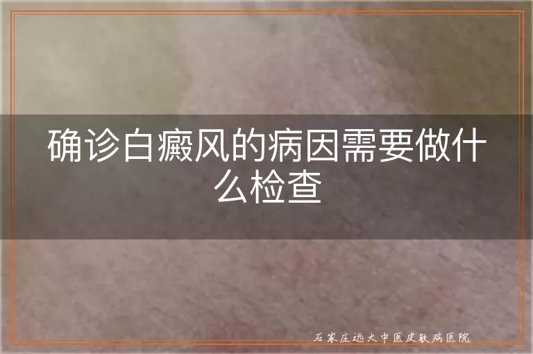 确诊白癜风的病因需要做什么检查