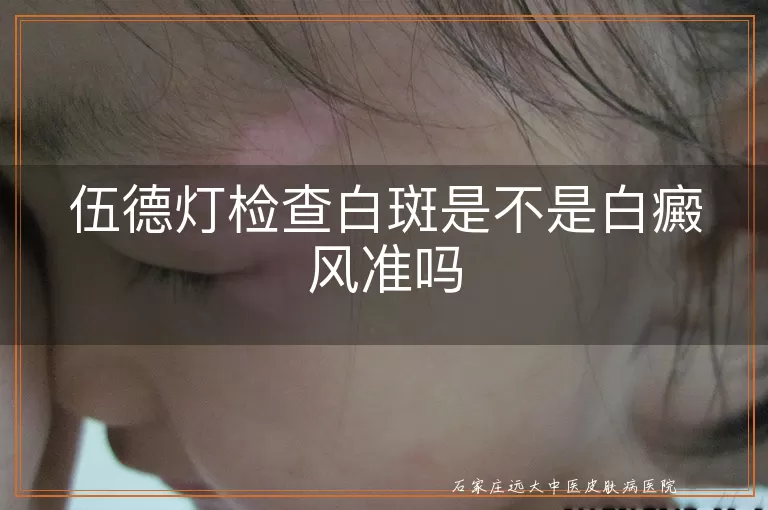 伍德灯检查白斑是不是白癜风准吗